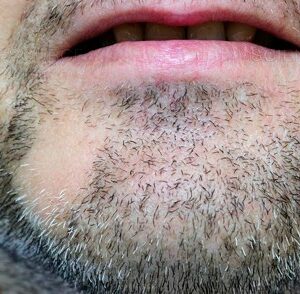 Alopecia-Areata Alopecia-Areata