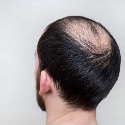 Haircuts to hide baldness - DHI Panamá