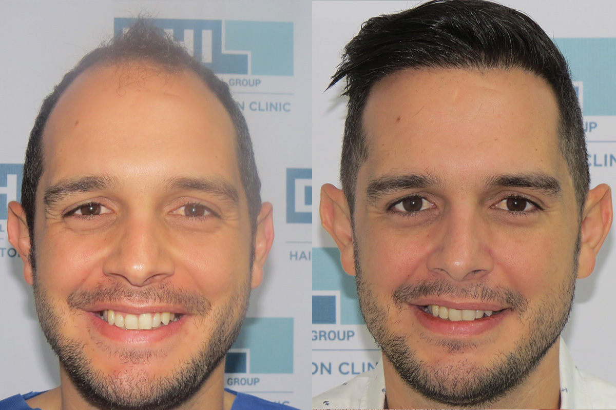 The truth about hair transplant procedures - DHI Panamá