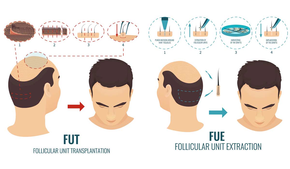 Diferencia entre el trasplante de cabello FUE & FUT