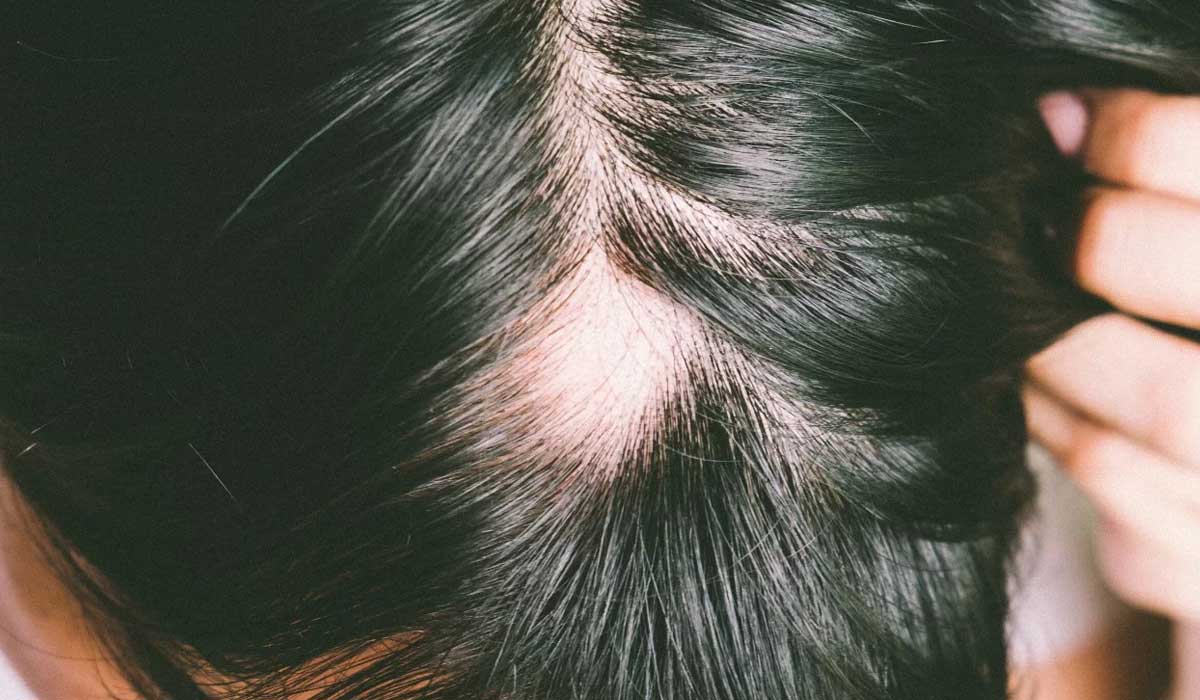 alopecia-areata en Latinoamérica