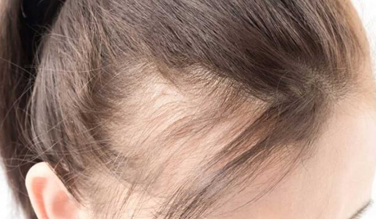 Hair loss front of head deals female