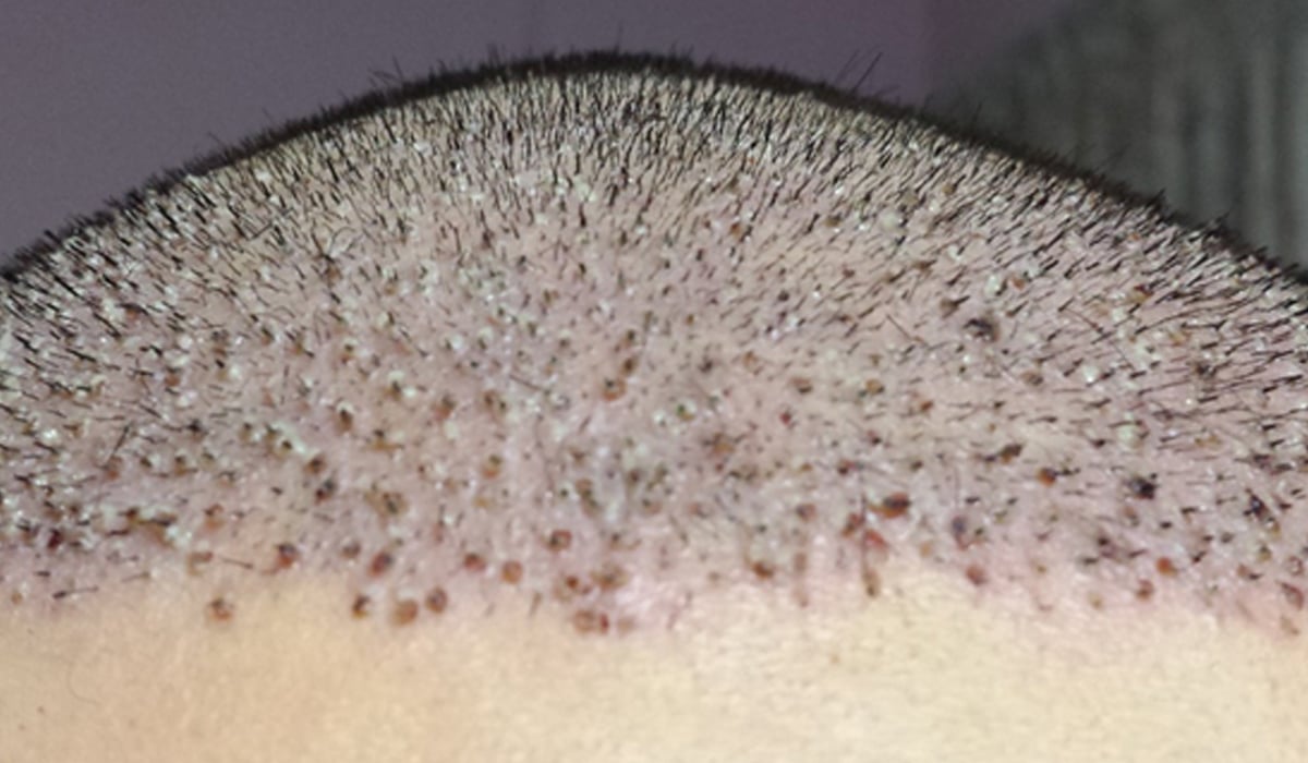 Scabs after hair transplant - DHI Panamá
