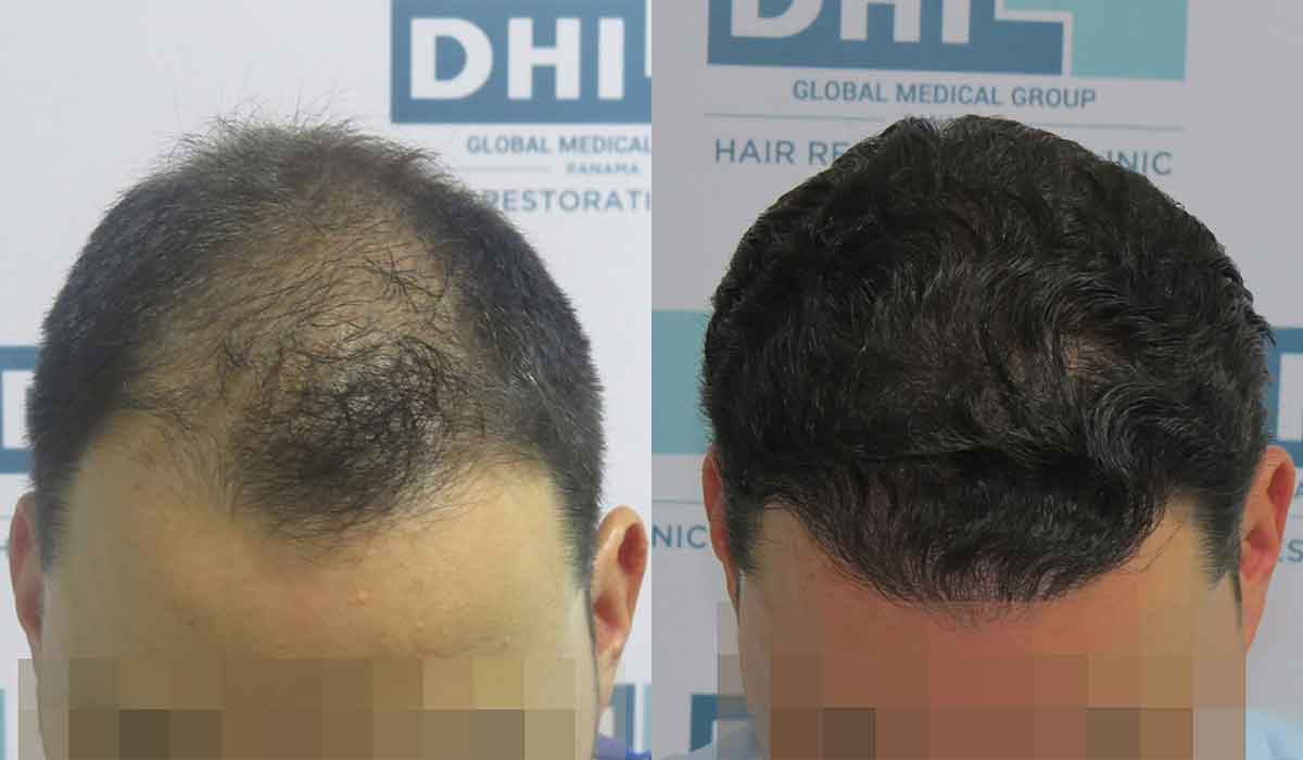 HAIR TRANSPLANT CAN DAMAGE EXISTING HAIR - DHI Panamá