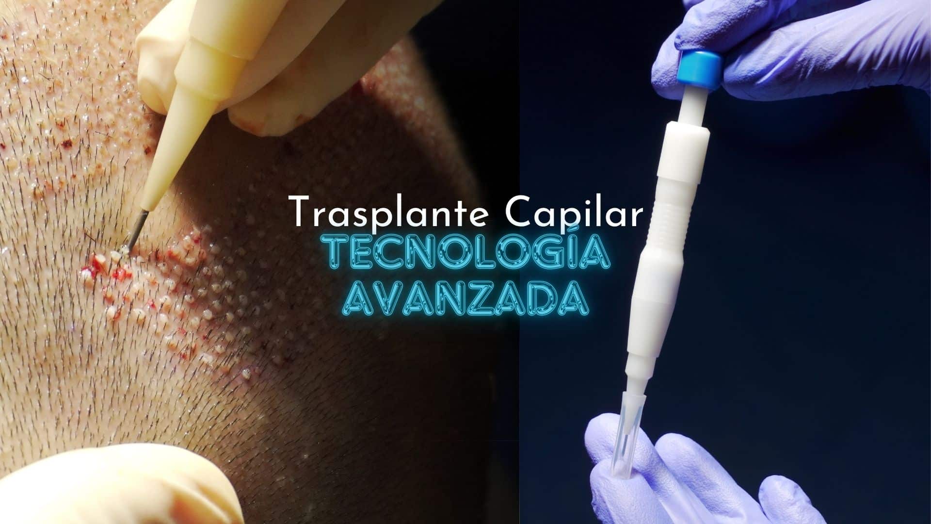 Trasplante Capilar en Panamá Tecnología Avanzada